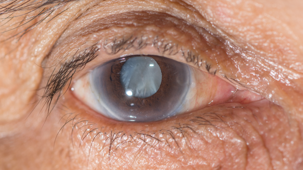 كيف تعرف انك تعاني من مرض المياه البيضاء في العين دكتور طارق عبد الحارس
